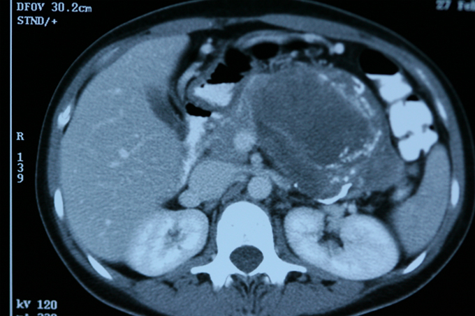 Kontrastlı Abdominal BT — Pankreas ve Karaciğer Kesiti